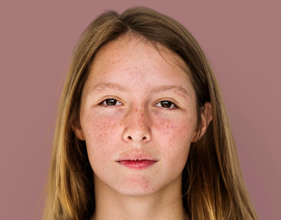 Acne In Children