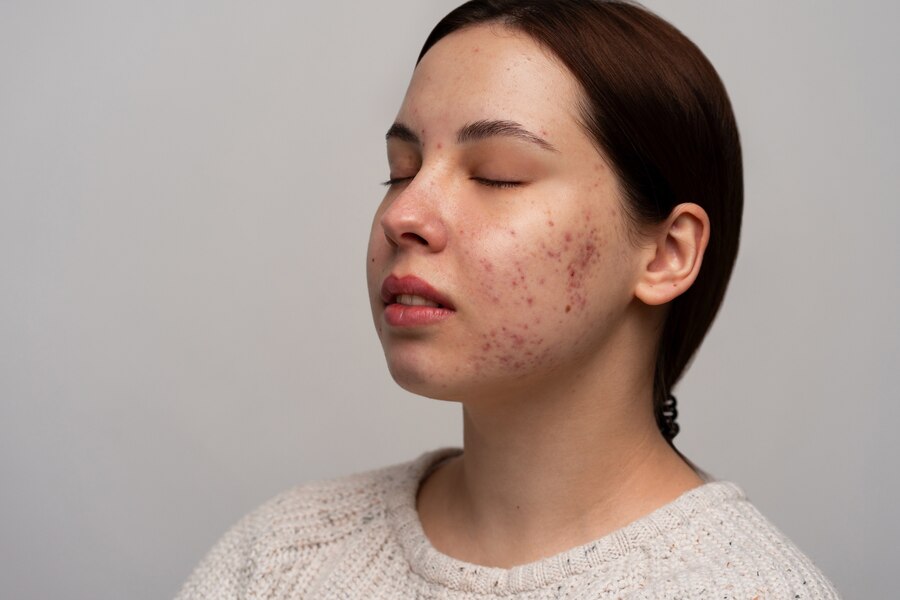 Hormonal Acne Treatments
