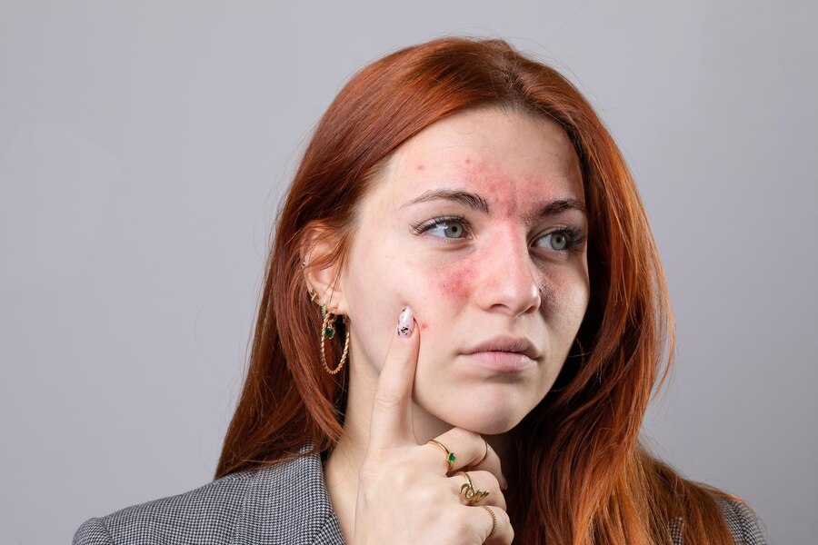 Acne Phototherapy