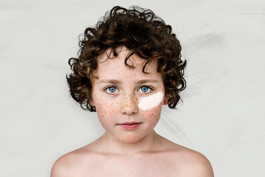 Ota birthmarks