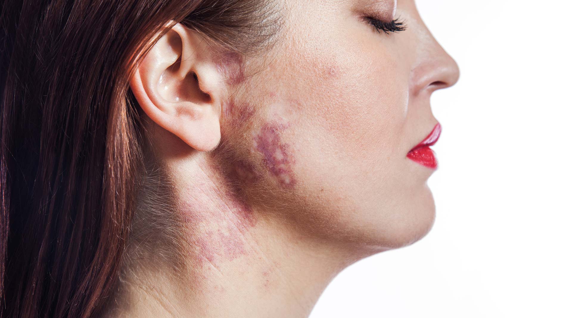 Port wine stain treatments