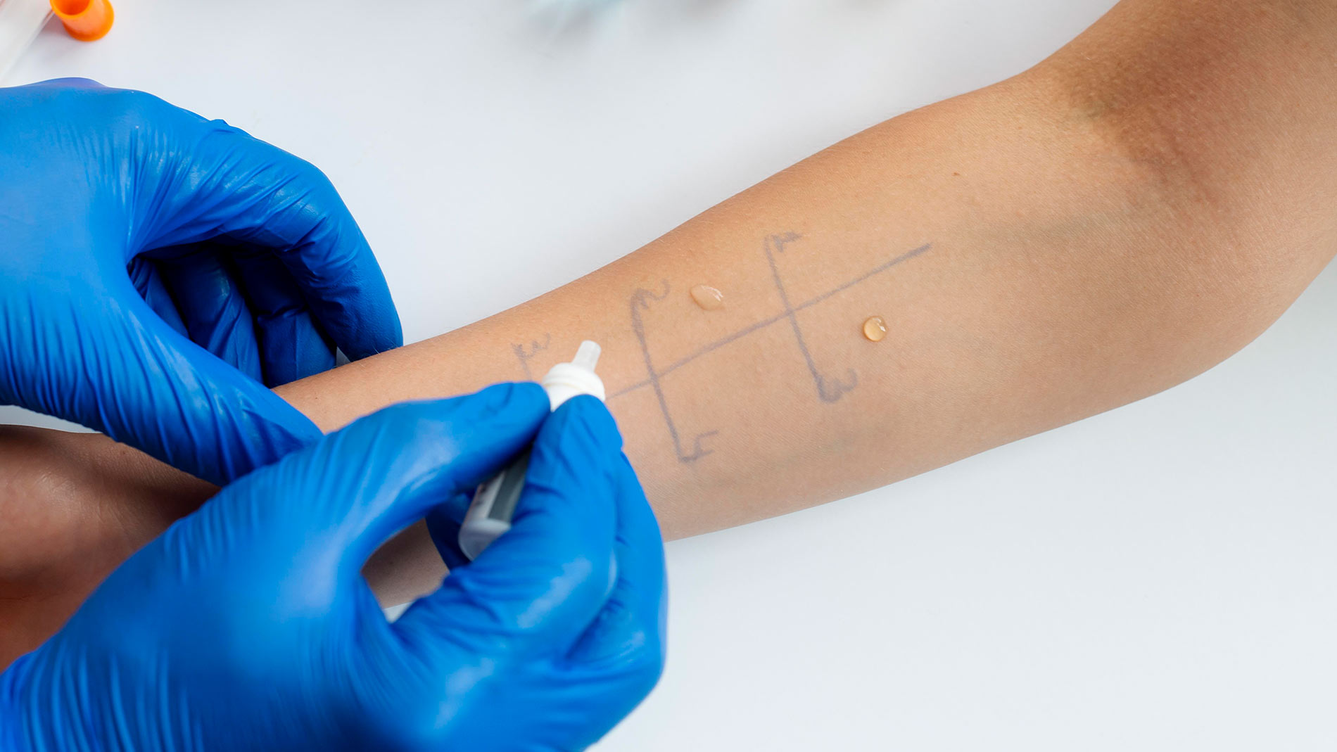Skin Allergies & Patch Testing