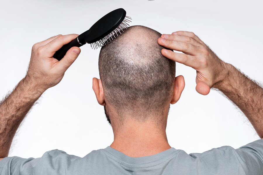 Alopecia Areata in hair